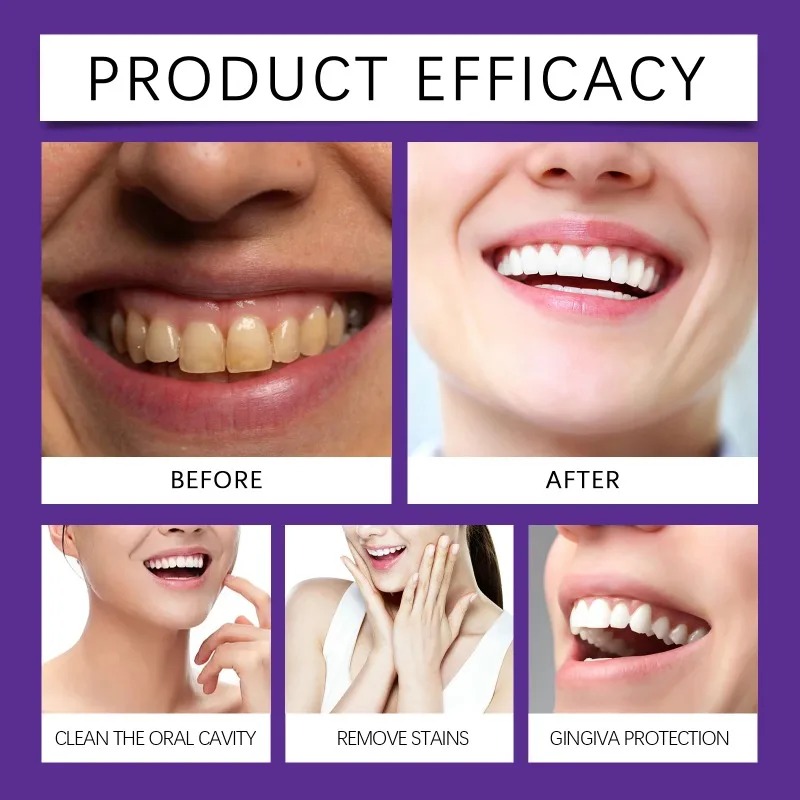 Purple Teeth Restoration Miner - Teeth Whitening Near Me recension och pris